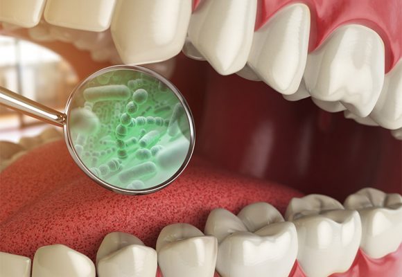 Cuidado: bactérias da boca podem levar a infecções graves