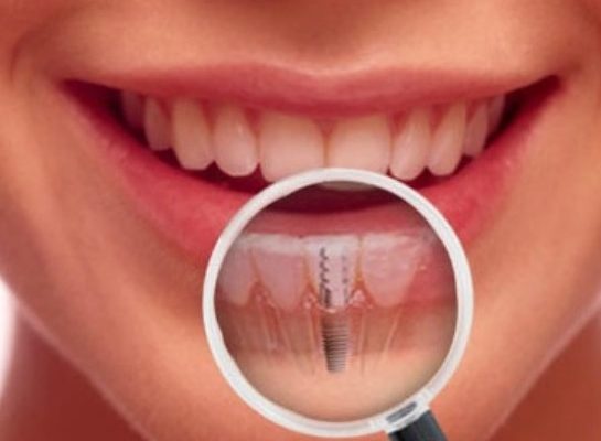 Saiba os benefícios dos implantes dentário