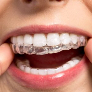 Quais os riscos do clareamento dentário?