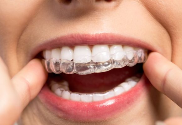 Quais os riscos do clareamento dentário?